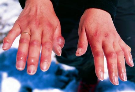 Обморожение